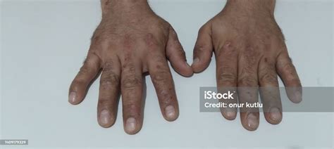 Tangan Pria Dengan Eksim Atopik Dermatitis Atopik Juga Dikenal Sebagai Eksim Adalah Peradangan