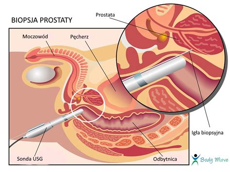 Badanie Prostaty Telegraph