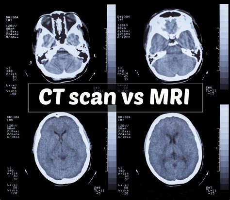You may also need to wear a hospital. MRI and CT Scan Comparison and Their Roles in Personal ...