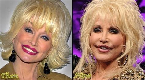 Dolly Parton before and after plastic surgery 07 ...