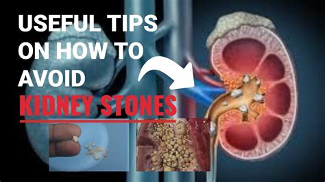 Useful Tips On How To Avoid Kidney Stones Youtube