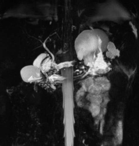 Magnetic Resonance Cholangiopancreatography Showing Multiple Pancreatic