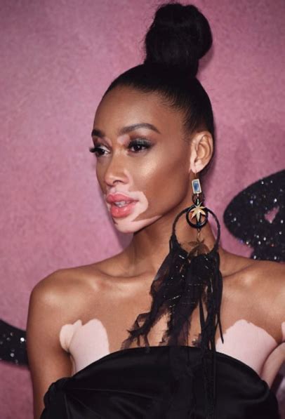 All You Need To Know About Vitiligo Truelove