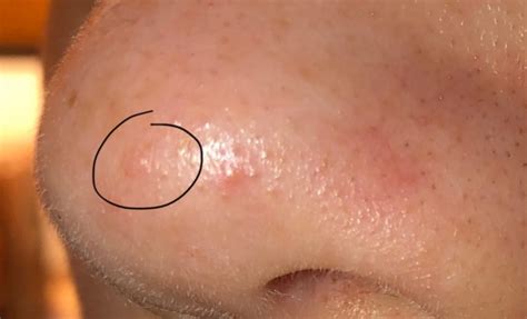 Skin Cancer Types On Nose Skin Cancer Plz Help Cancer Forums