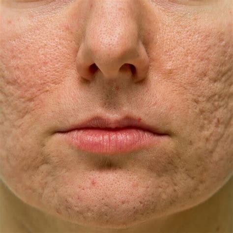 How To Reduce The Appearance Of Acne Scars Healthstatus