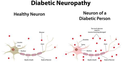 A Study On Effect Of Naturopathy In Diabetes Control Without Medicine