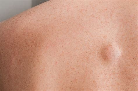 Cysts Diagnosis Causes And Treatment Toronto Dermatology Centre