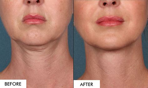 Thermismooth Rf Before After The Beauty And Cosmetic Clinic 70 Pitt St