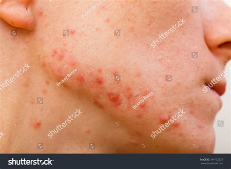 Acne Skin Because The Disorders Of Sebaceous Glands Productions Stock