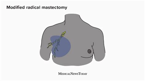 Mastectomy Anatomy