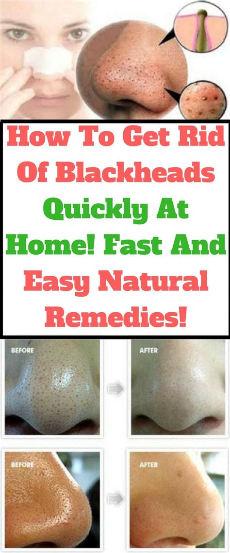 How To Get Rid Of Blackheads Quickly At Home Fast And Easy Natural