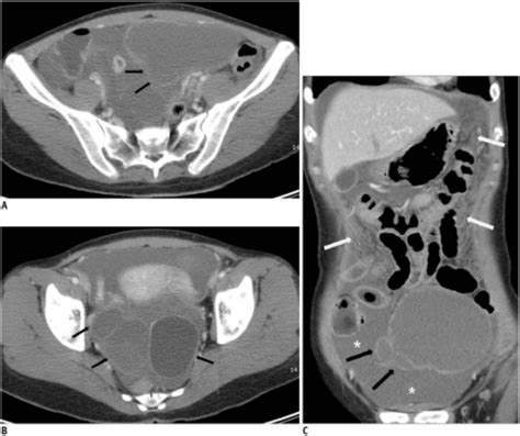 Figure 1ct Imaging Findings Of Ruptured Ovarian Endometriotic Cysts