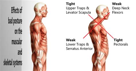 Stop Slouching What Is Bad Posture And How To Correct It Tri Covery Massage And Flexibility