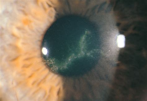 Corneal Abrasion And Ulceration Diseases And Conditions 5minuteconsult