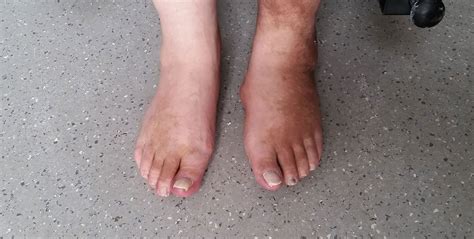 We did not find results for: Charcot-Fuß - diabetischer Fuß mit Spontanbrüchen bei ...