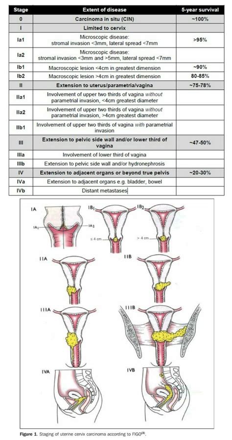 carcinoma cervix staging cervix pathology staging