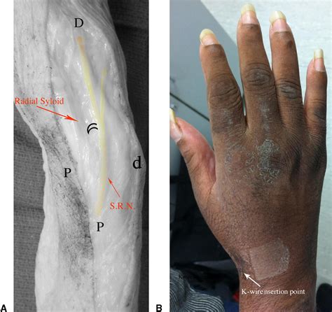 Radial Styloid Fractures Journal Of Hand Surgery