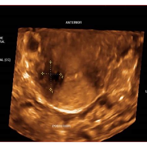 3dtvs rendering mode of the transverse view of the cervix demonstrating download scientific