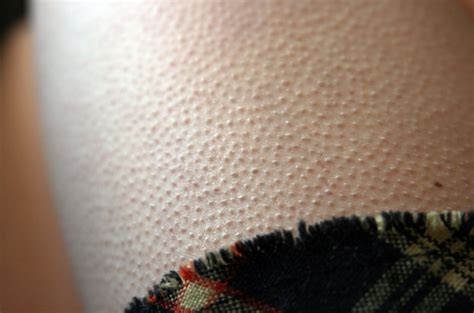 Why Do We See Goosebumps On Our Skin Qrius