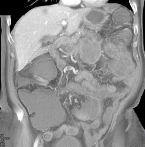 Impressive Pneumatosis Coli In 3d Colon Case Studies Ctisus Ct Scanning