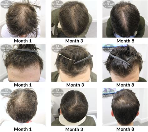 Success Story Alert New Male Hair Loss Treatment Entry