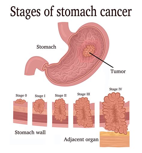 Stomach Cancer Saint Johns Cancer Institute