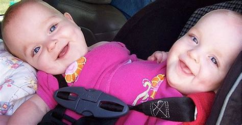 This Inspiring Story Of The Rarest Triplets In The World Will Surely Make You Smile Conjoined