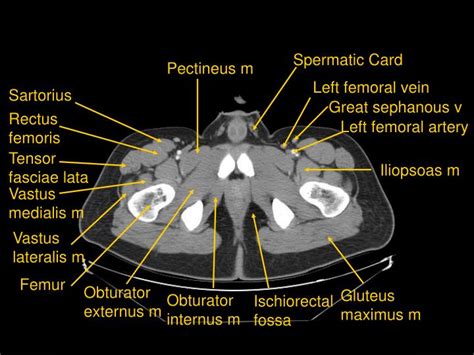 PPT - CT of Abdomen and Pelvis PowerPoint Presentation - ID:3031526