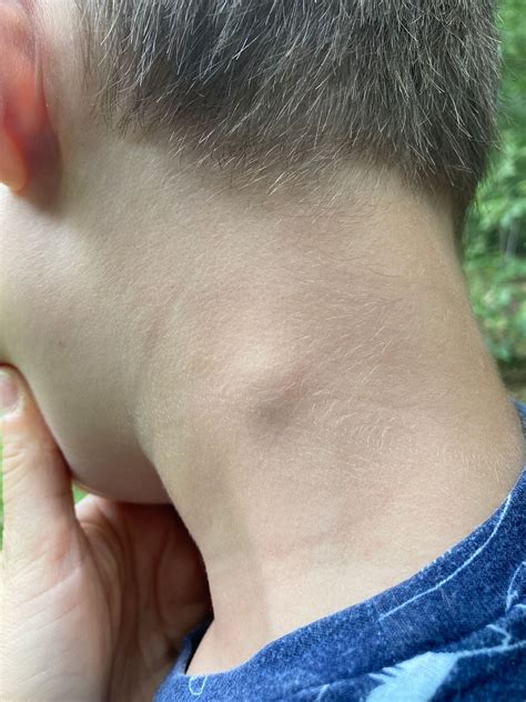 Lump On Childs Neck Page 3 Babycenter