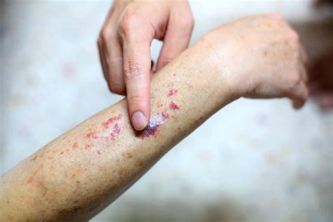 Purple Spots On Skin Purpura Causes Treatment And Diagnosis K Health