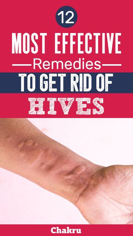 Quick Remedies To Get Rid Of Hives Naturally And Safely Home Remedies