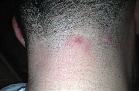 Pimples On Back Of Neck What Are They And How To Treat Them Enkivillage