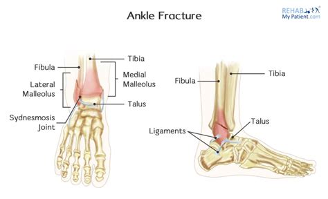 Ankle Fracture Rehab My Patient