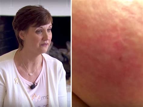 Woman Shares Photo Of Inflammatory Breast Cancer Symptom In Hope Itll