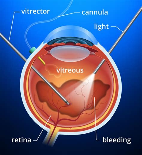 Vitreo Retinal Surgery Retinal Detachment Endophthalmitis