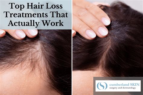 Which Hair Loss Treatments Work Find Out Here From A Dermatologist