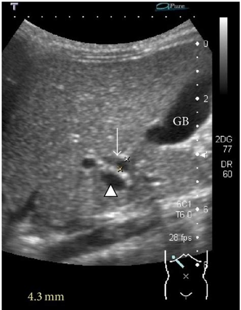 Common Bile Duct Dilatation On Ultrasound Arrow The Open I