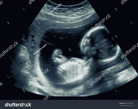 Ultrasound Human Fetus During 16th Week Stock Photo 552169927