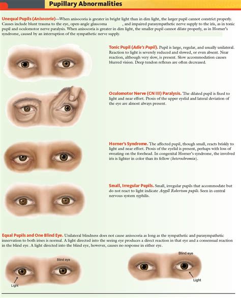 Pupillary Abnormalities Overview Unequal Pupils Anisocoria Tonic