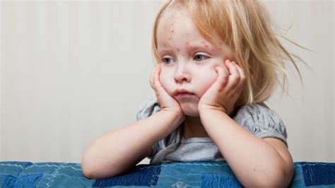 Exanthematous Diseases In Children Conaup Kids Caring