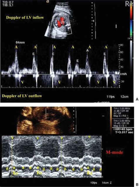Scielo Brasil Congenital Complete Atrioventricular Heart Block In A