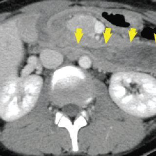 Abdominal CT Showing A 7 Cm Mass Extending From The Bulb To The