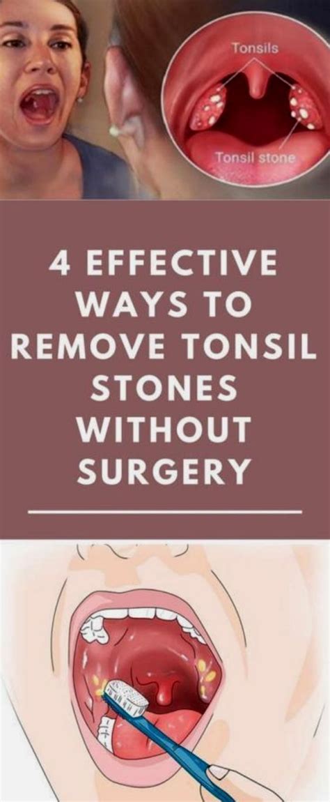 4 Effective Ways To Remove Tonsil Stones Without Surgery Healthy Visual