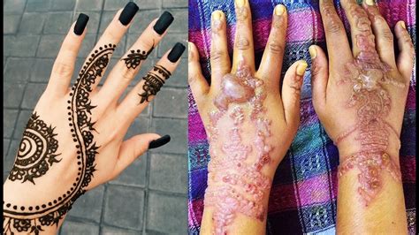 Temporary Black Henna Tattoos Can Be Painfully Permanent Youtube
