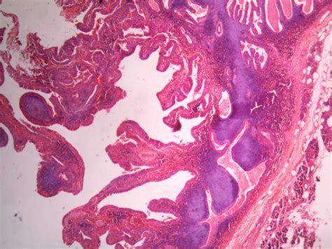 Warthins Tumor Histopathologyguru