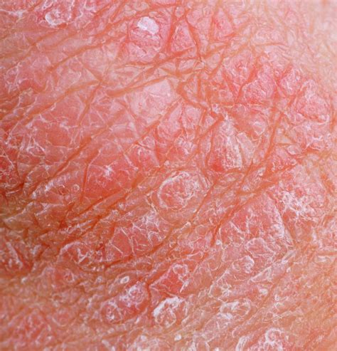 How Can I Tell The Difference Between Some Common Skin Rashes