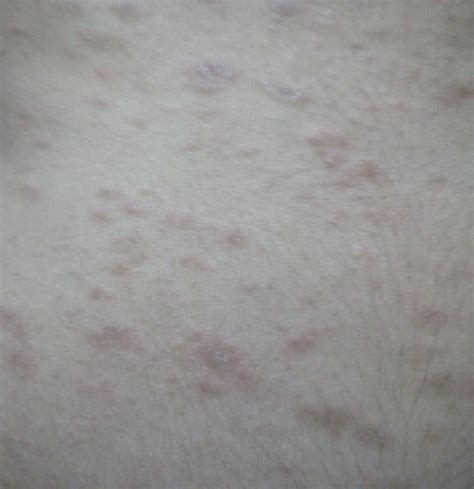 Ask A Dermatologist Online For Red Patches Pimple On Body