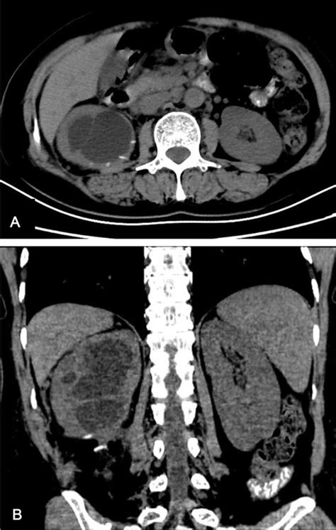 Frontiers Prolonged Postoperative Urine Leakage Due To A Calyceal Diverticulum Mimicking A