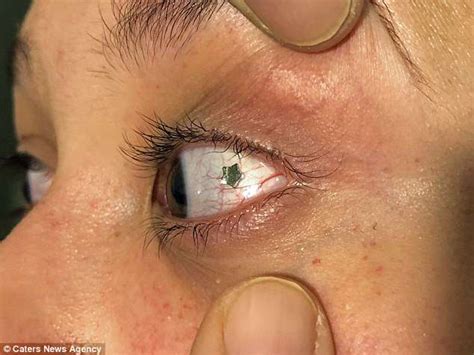 Nyc Doctor Shares Moment He Performs Eyeball Jewellery Surgery Daily