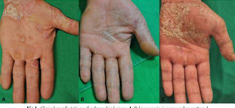 Figure 1 From The Histopathological Differentiation Between Palmar